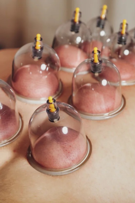 الحجامة الرياضية