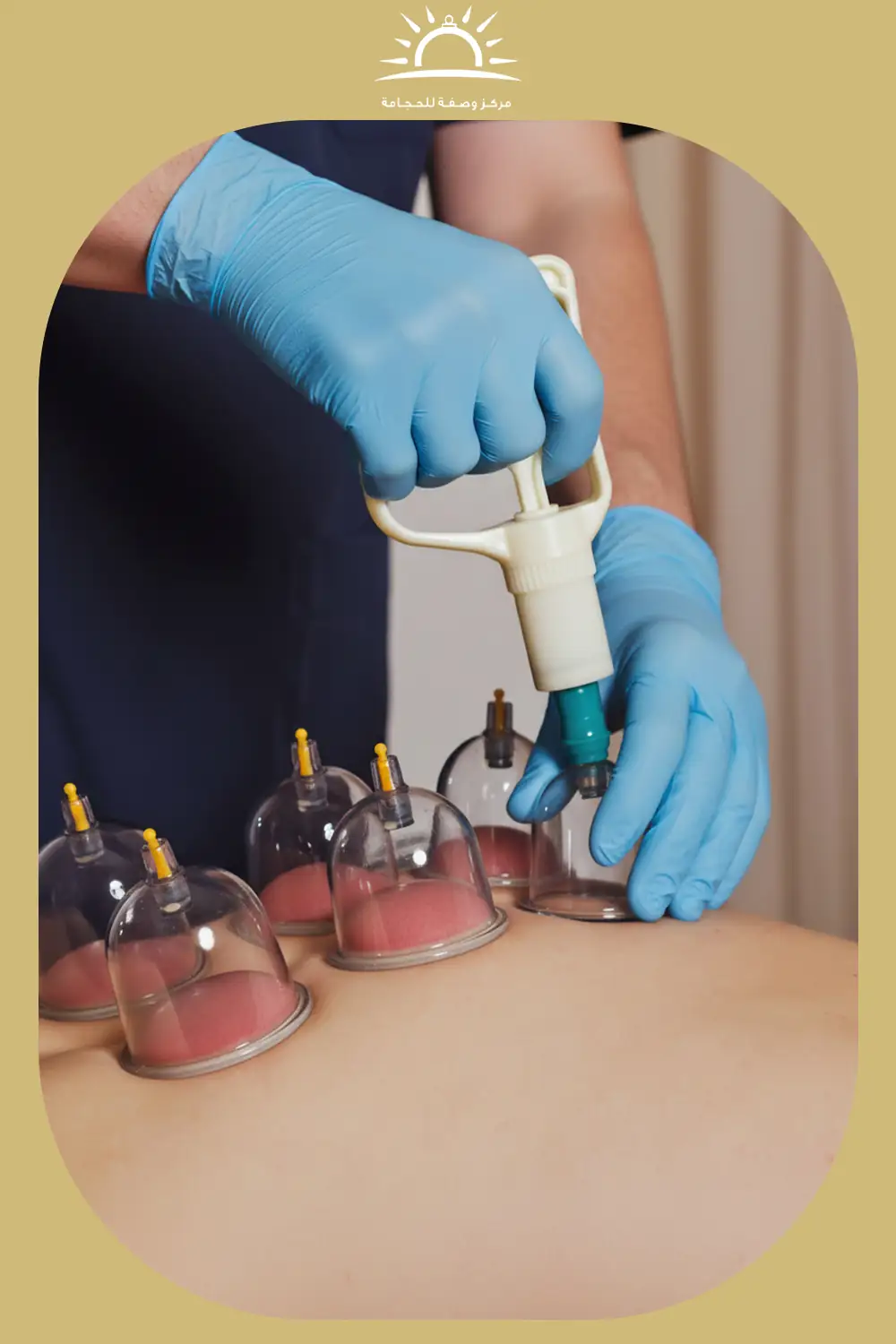 الحجامه العلاجيه